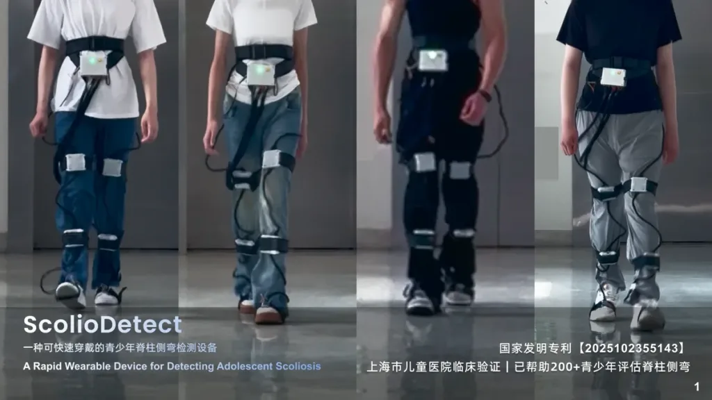 ScolioDetect: The AI-Powered Wearable Transforming Early Scoliosis Detection 1 ScolioDetect: The AI-Powered Wearable Transforming Early Scoliosis Detection